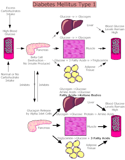 Diabetes  Mellitus Type 1