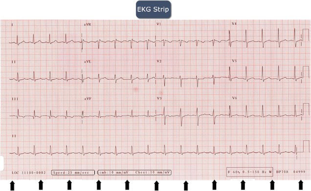 EKG strip