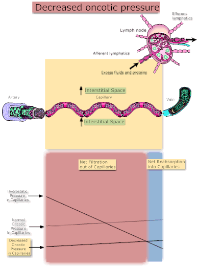 Decreased Oncotic Pressure